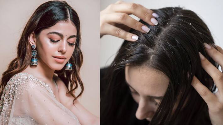 7 hair packs to get rid of dandruff skip expensive products