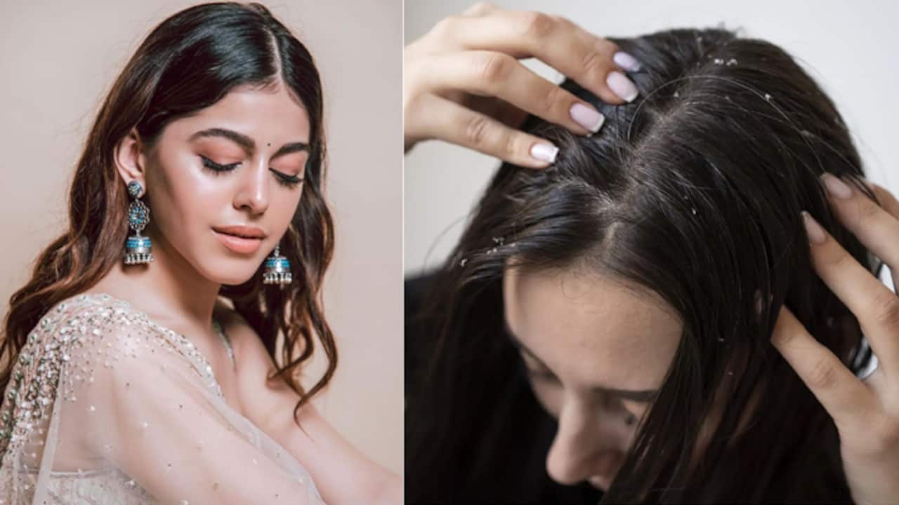7 hair packs to get rid of dandruff skip expensive products