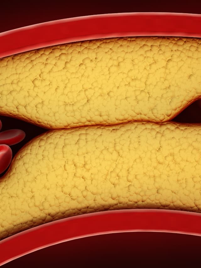 foods you should avoid if you have bad cholesterol