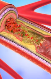 Foods That Increase Bad Cholesterol