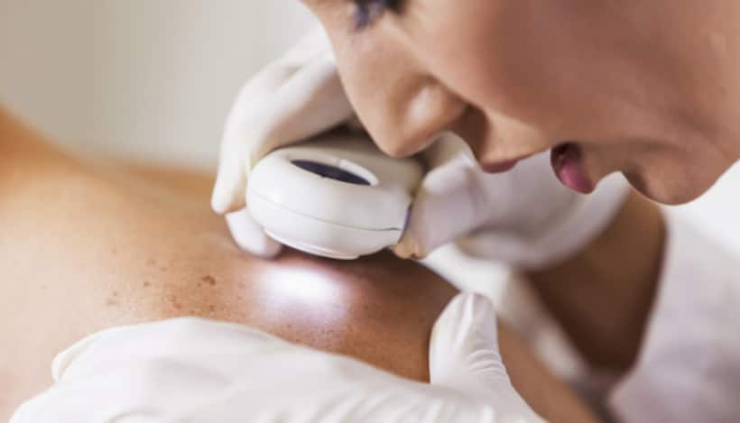 skin cancer