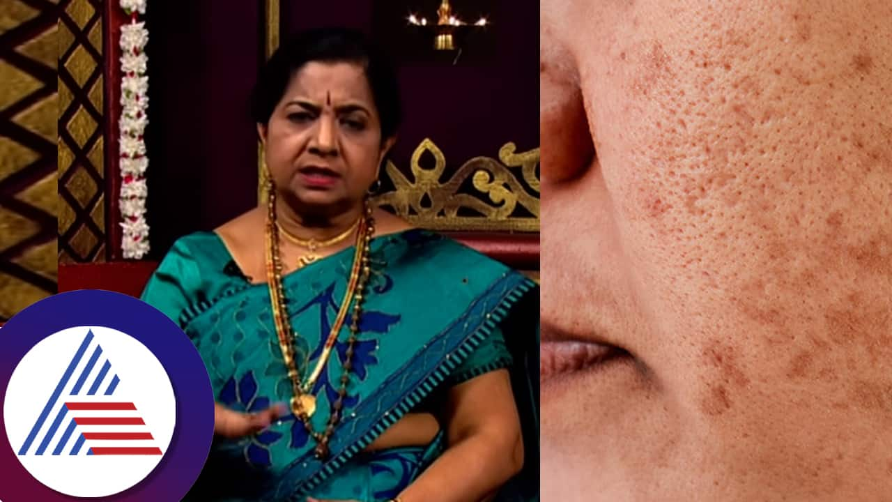 Ayurvedic expert Dr Gowriamma about pigmentation problem on your face suc