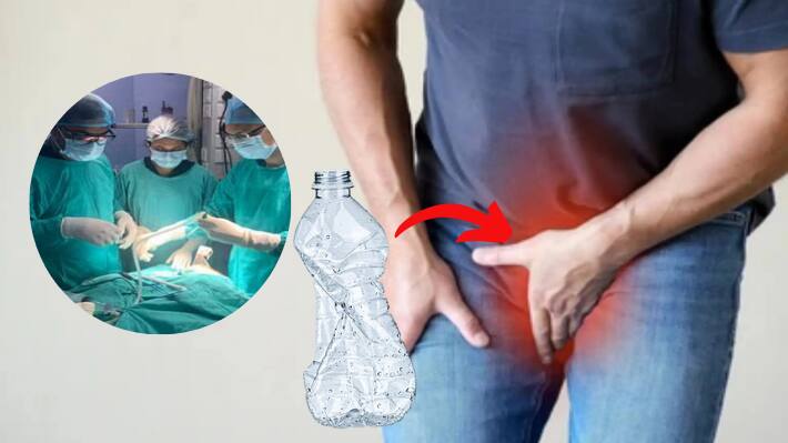 Prayagraj Engineering Student Got Bottle Stuck In Private Part Doctors Took It Out