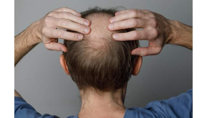 Understanding the Causes of Hair Loss: Expert Insights and Prevention Tips