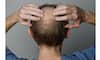 Understanding the Causes of Hair Loss: Expert Insights and Prevention Tips