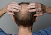 Understanding the Causes of Hair Loss: Expert Insights and Prevention Tips