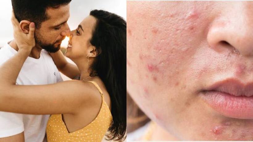 Intimacy can cause acne 