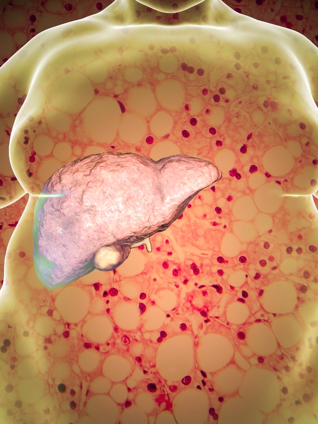 7 things that can cure fatty liver