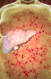 7 things that can cure fatty liver