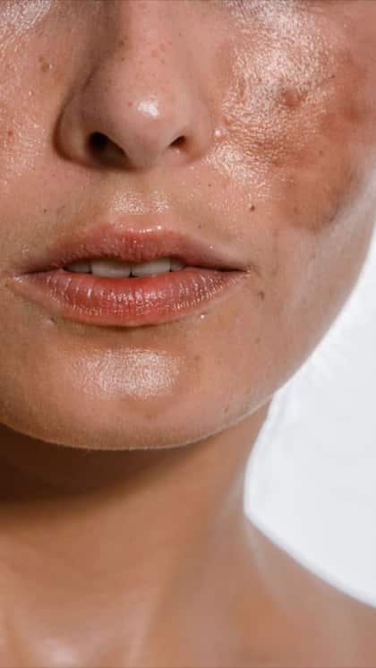 Excessive UV Exposure