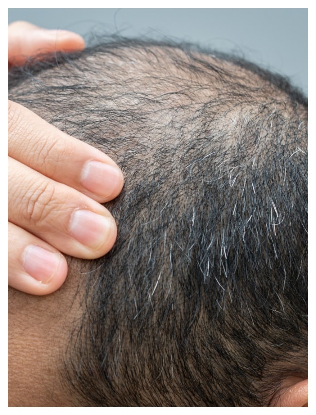 reasons behind baldness in young people