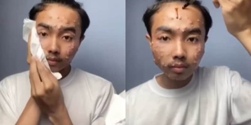 Youth Develops Painful Skin Disease After Wearing Unwashed Thrifted Clothes video goes viral