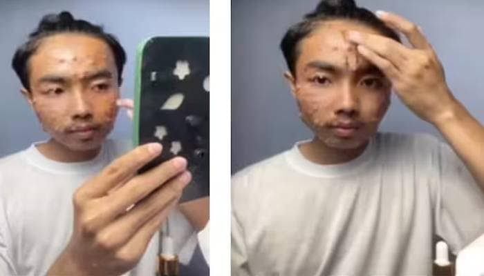 man wearing unwashed clothes from thrift store suffered by skin disease