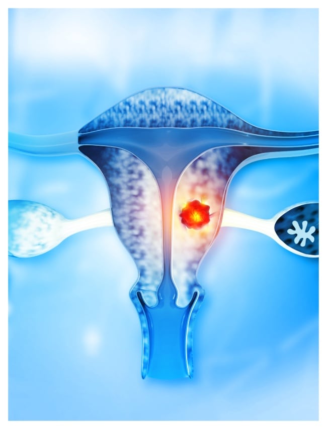 common causes behind ovarian cancer in woman 