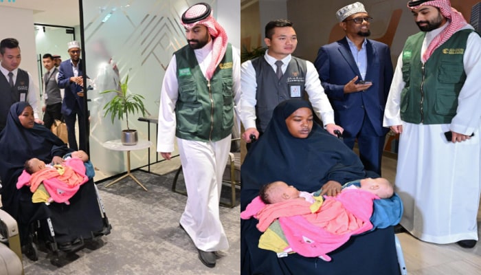somalin conjoined twins reached riyadh for separation surgery 
