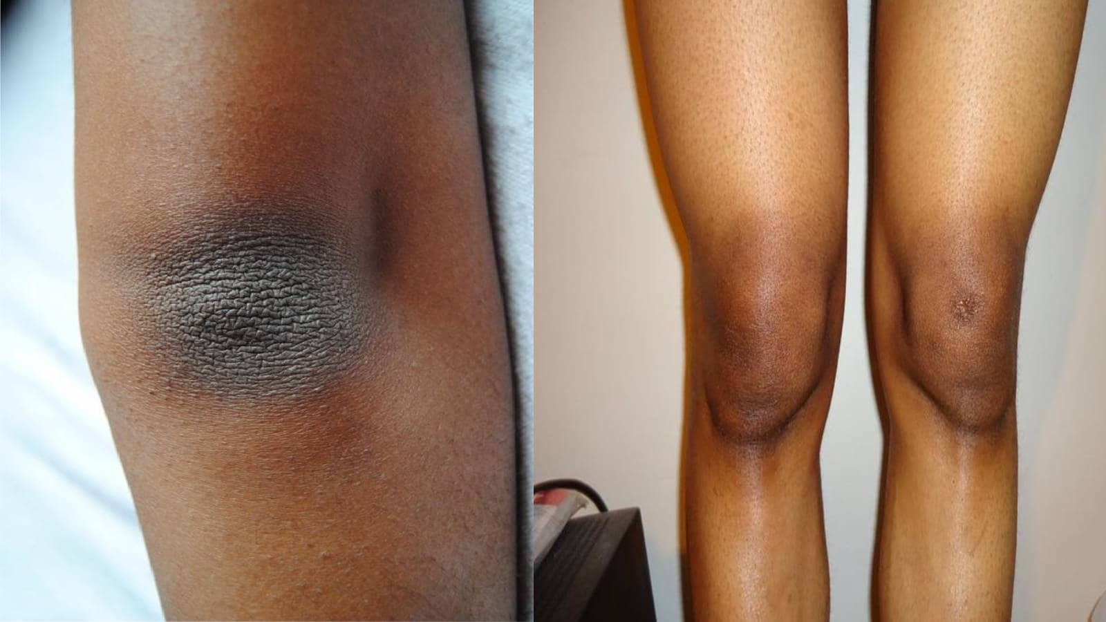 homemade beauty tips for dark knees and elbows in telugu ram