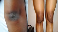 homemade beauty tips for dark knees and elbows in telugu ram
