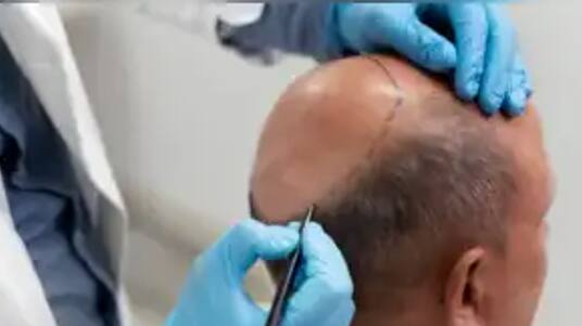 hair transplant 