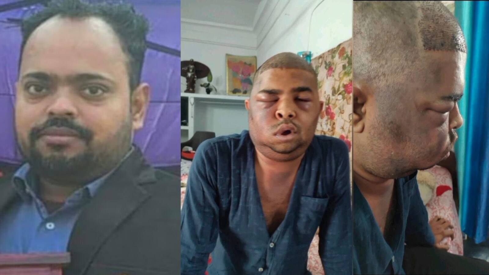 Kanpur hair transplant death