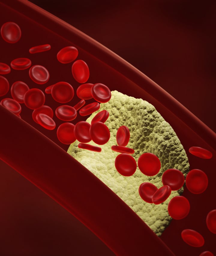 avoid these foods if you have high cholesterol levels