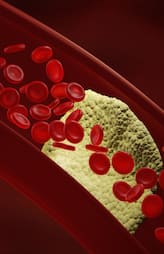 avoid these foods if you have high cholesterol levels