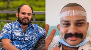 vijay madhav shares his hair transplant experience vijay madhav shares his hair transplant experience