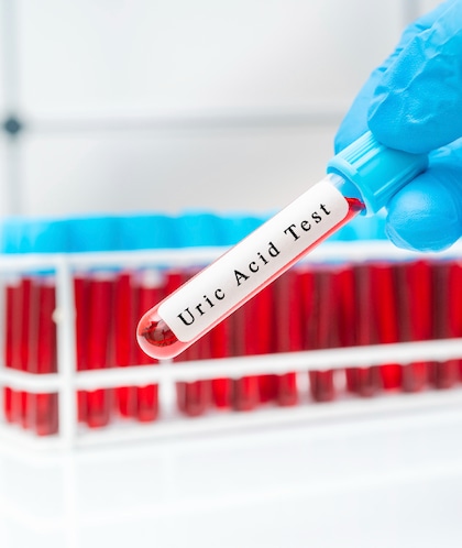 Foods that raise uric acid