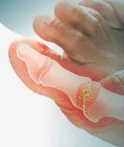 హైపర్ యూరిసెమియా