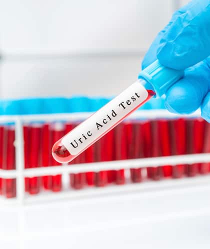  Uric Acid: రక్తంలో యూరిక్ యాసిడ్ పెరిగితే.. ఈ లక్షణాలు కనిపిస్తాయి 