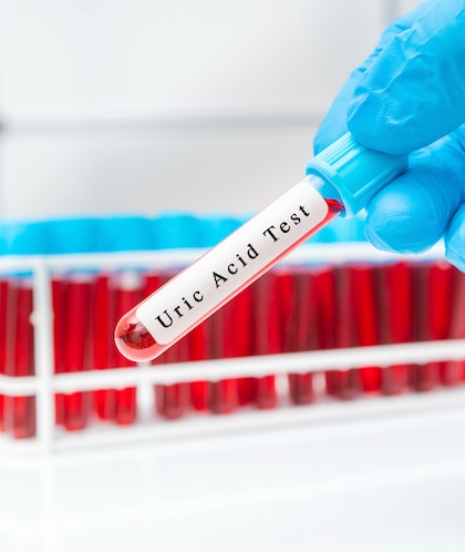  Uric Acid: రక్తంలో యూరిక్ యాసిడ్ పెరిగితే.. ఈ లక్షణాలు కనిపిస్తాయి 