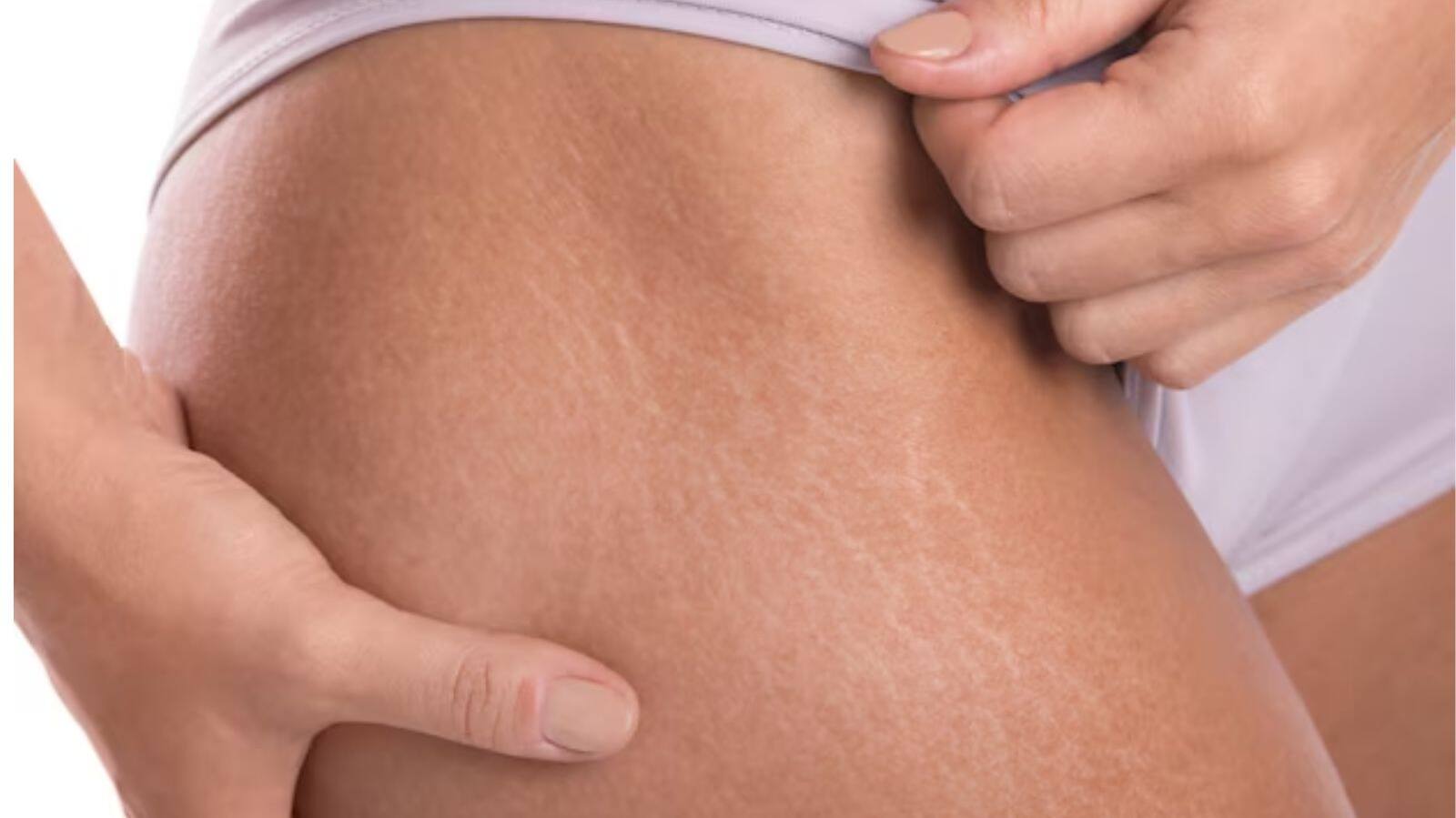 what is stretch marks and how to cure it