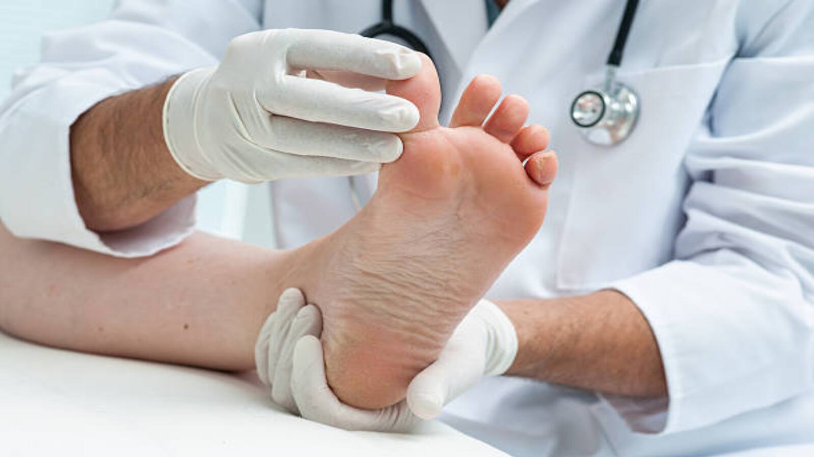how to prevent fungal infections in summer simple tips to stay safe