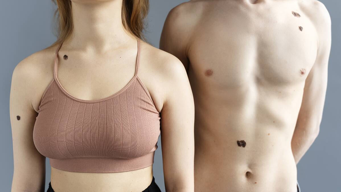 Unlucky moles on body