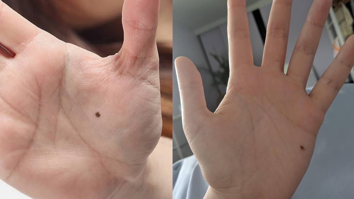 Right or left hand mole meaning