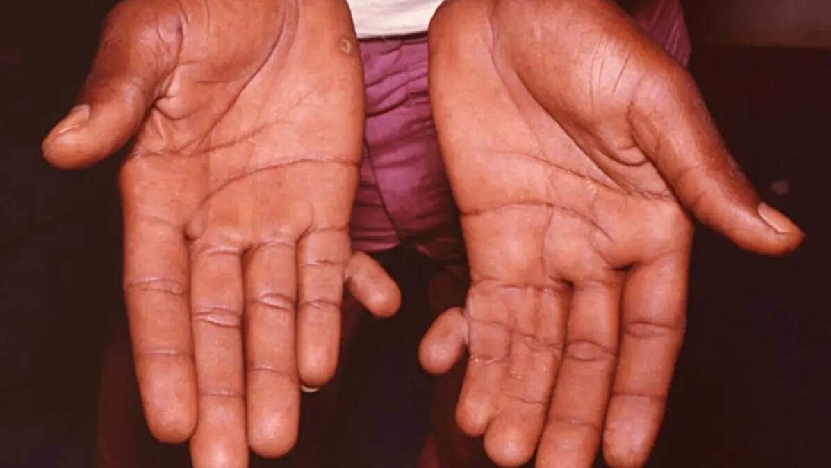 Is having 6 fingers lucky or unlucky