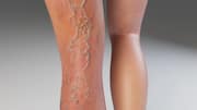Why Do Varicose Veins Appear? Simple Fixes Before They Become a Problem