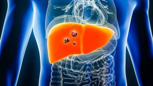 liver tumor