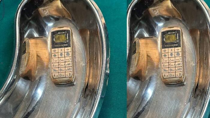 mobile phone removed from the stomach
