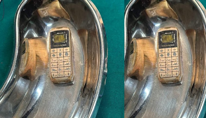 mobile phone removed from the stomach