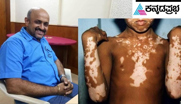 vitiligo