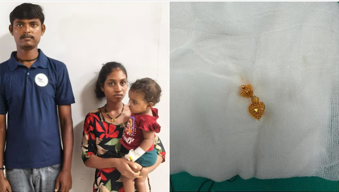 11-Month-Old Infant Swallows Gold Earring; Surat Doctors Save Her in 45 Minutes