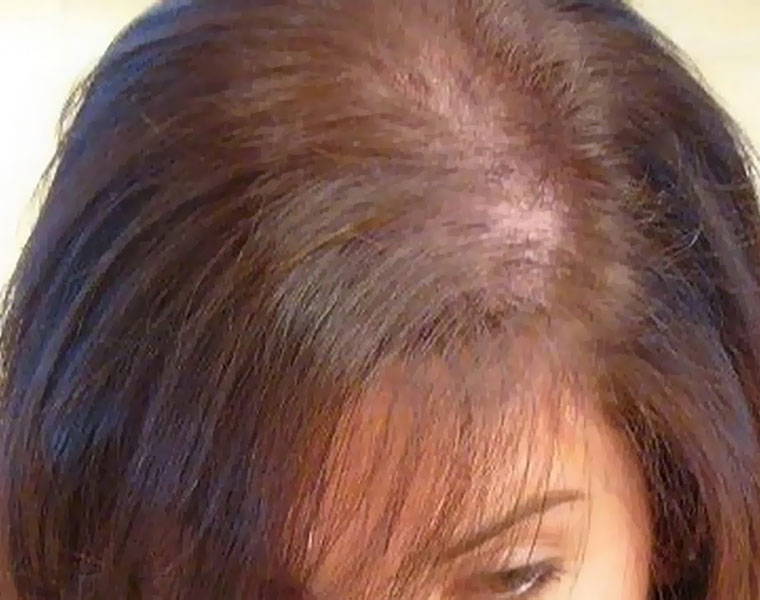 reasons for female pattern baldness know how to prevent and treat it in tamil mks