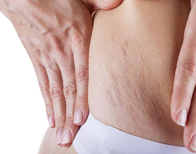 How To Remove Stretch Marks After Pregnancy