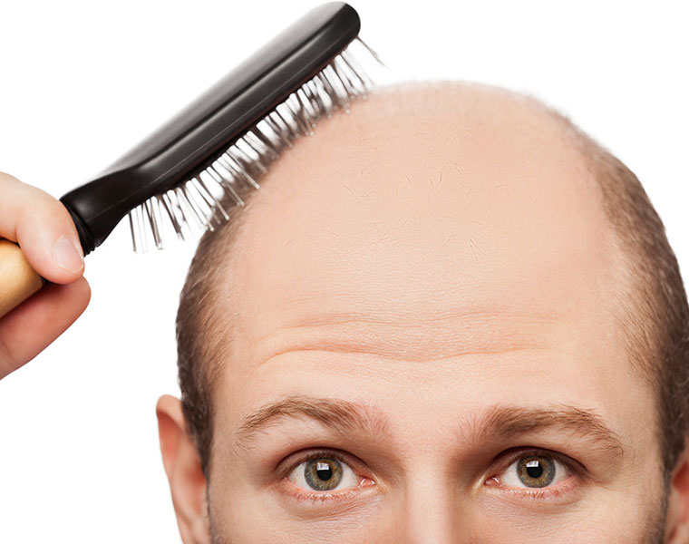 Five Ayurvedic remedies to cure baldness