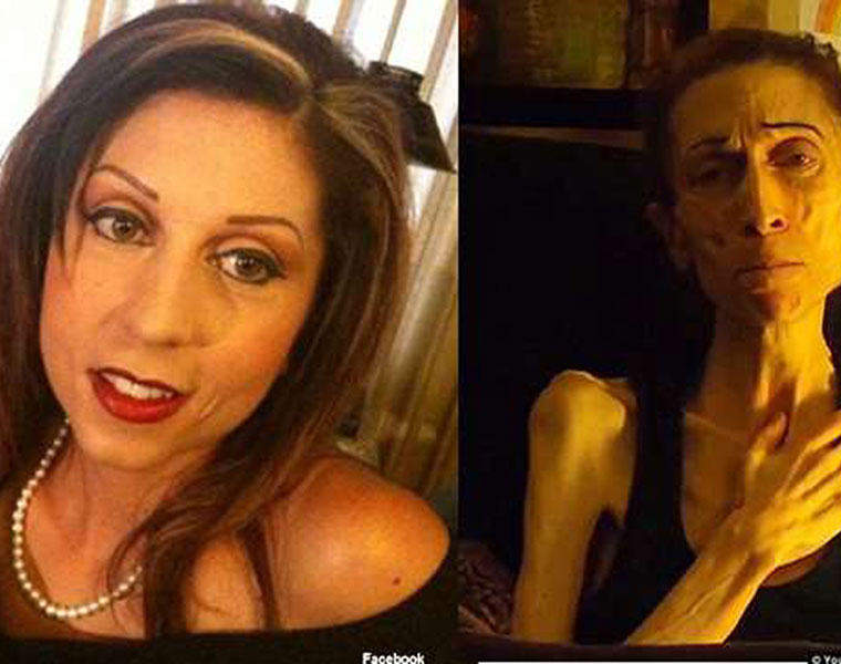 Anorexic actress Rachael Farrokh