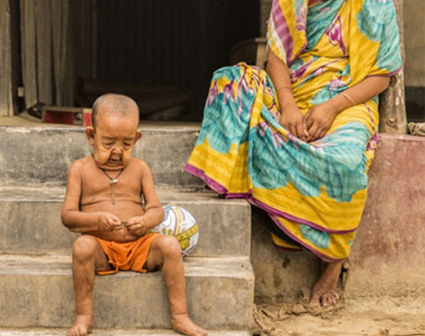 4-year-old kid with rare medical condition looks like an old man