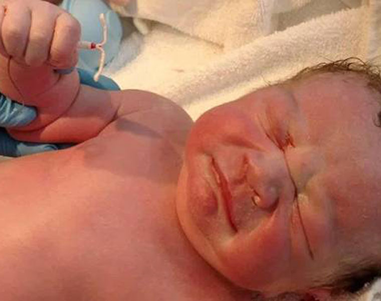 Baby born pregnant with his twin brother