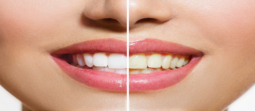 Home remedies to get White Teeth in Tamil 