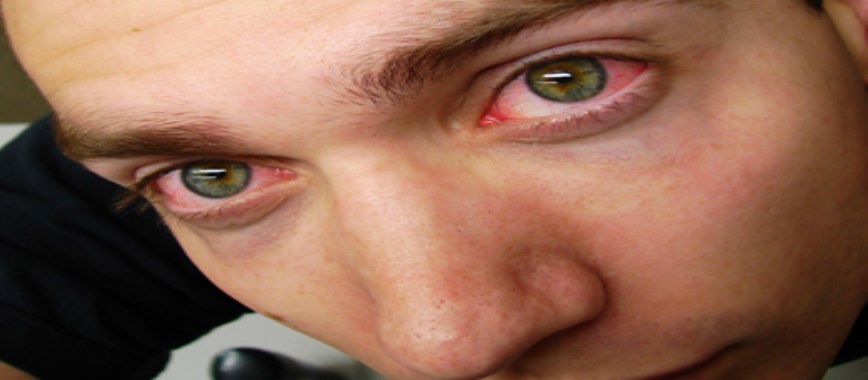 red eyes causes and home remedies