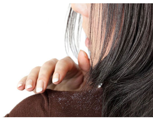 Get rid of dandruff